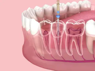 Чистка та ендодонтичне лікування каналів зуба