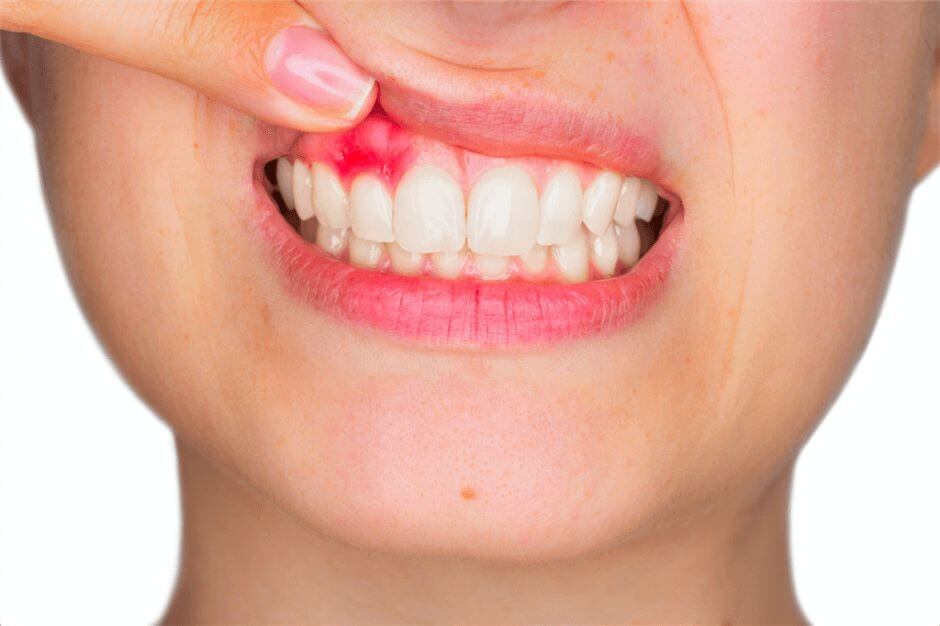 удаление кисты зуба в стоматологической клинике фото