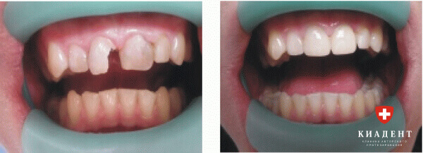 наращивание переднего зуба фото